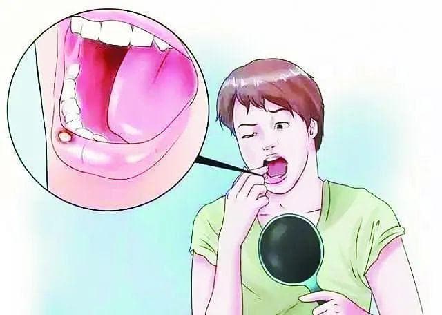 口腔溃疡是上火吗？会传染吗？常用食疗方→