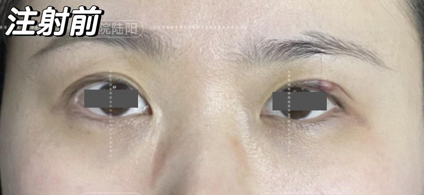 科普：了解霰粒肿及其治疗方法