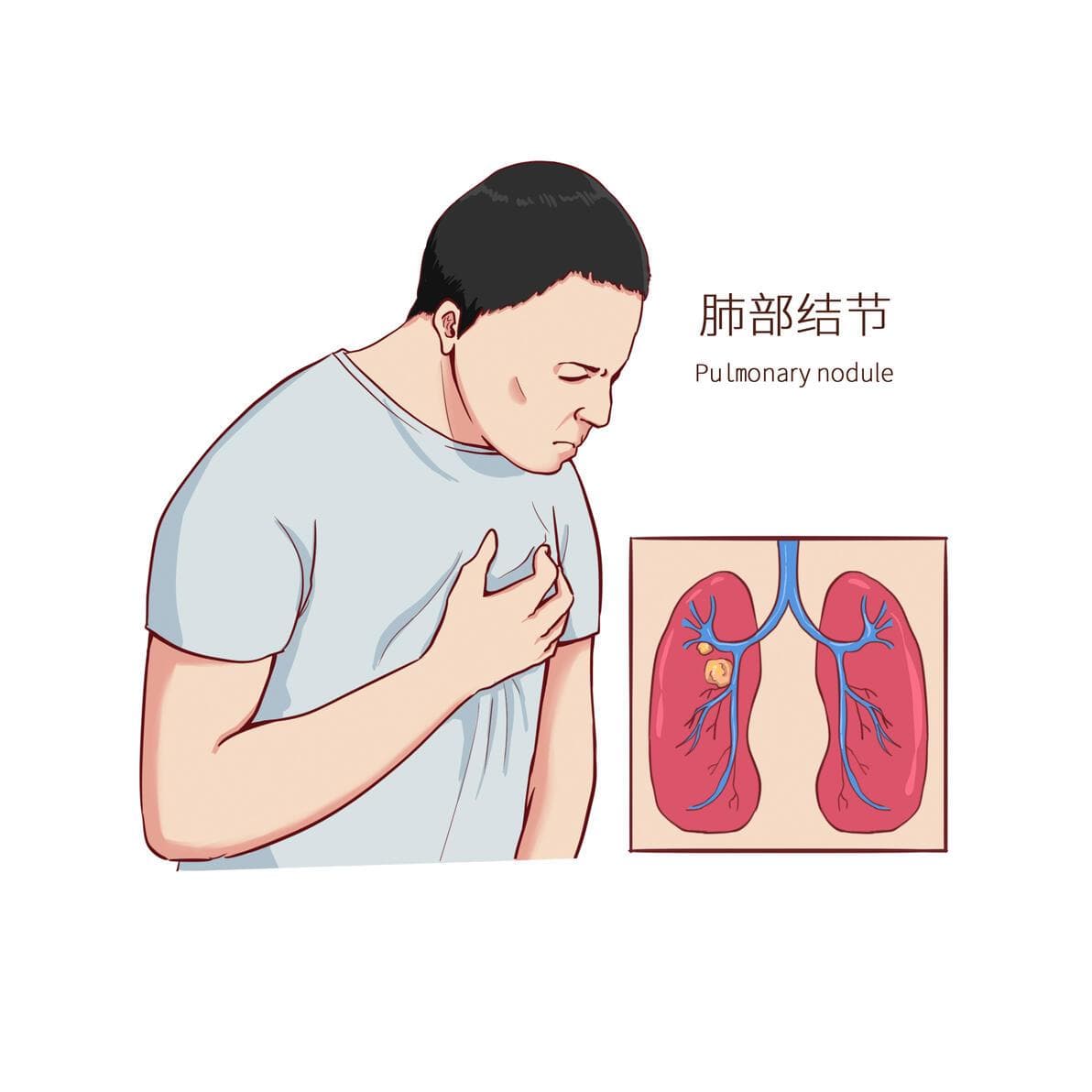 从饮食到中药：中医调理助力肺结节术后恢复