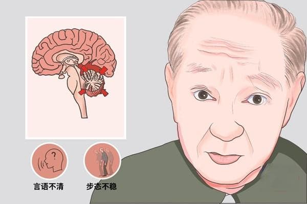 中医针灸疗法：神奇的治疗脑萎缩方法