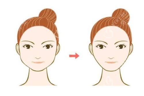伴随自己二十多年的婴儿肥脸怎么瘦下来：医疗美容知识解读及改善方案