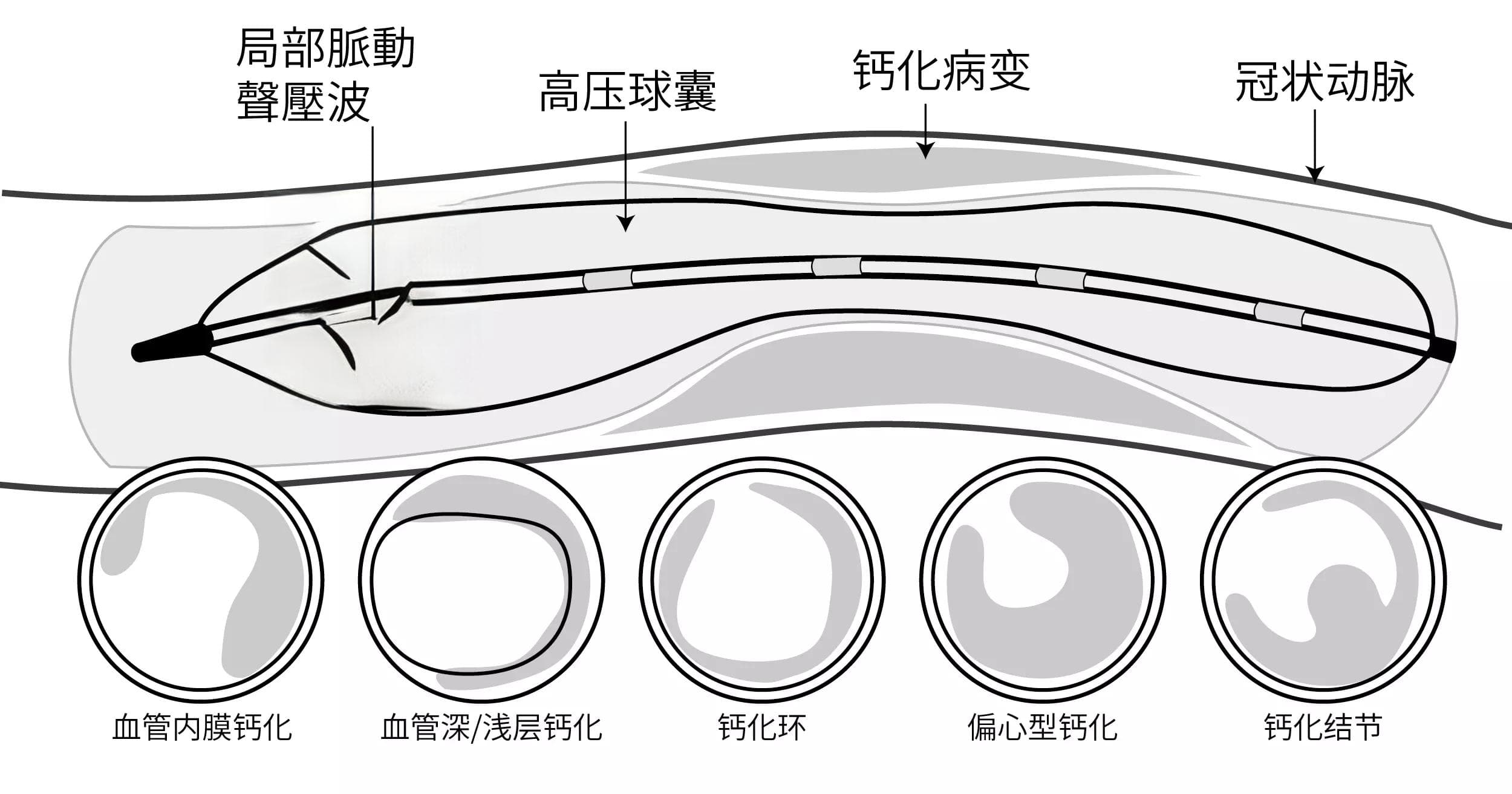 冲击波血管碎石术(IVL)：冠状动脉壁钙化处理的技术革新
