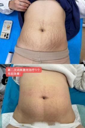 告别皱纹痘坑，二氧化碳点阵激光让肌肤重焕青春