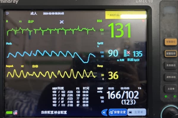 心电图异常Q波的成因与心脏保健指南