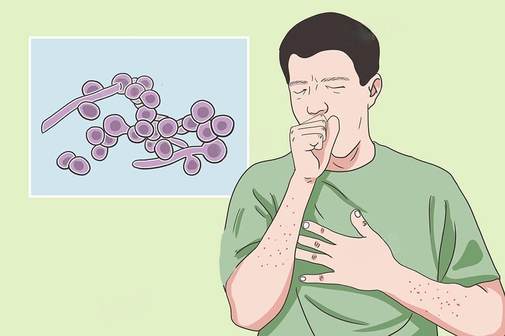霉菌是终身病吗？详解霉菌感染的症状、影响因素与预防方法