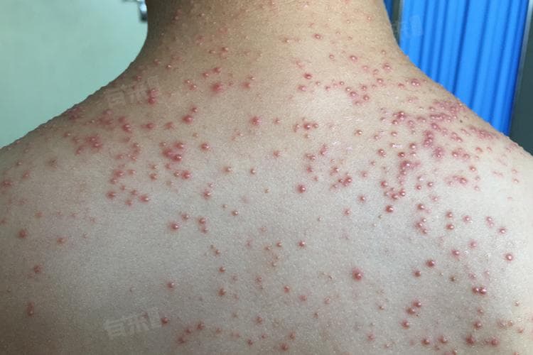 背部出现红疙瘩的五大原因及应对方法