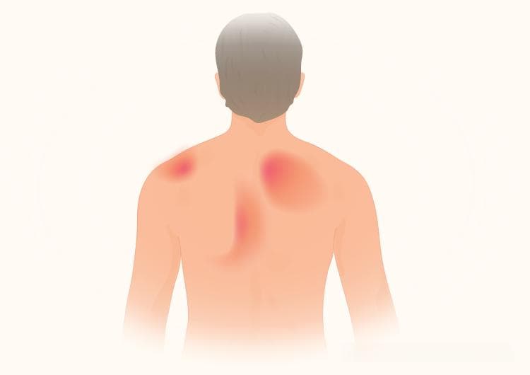 肩胛骨疼痛的9种病因和7种治疗