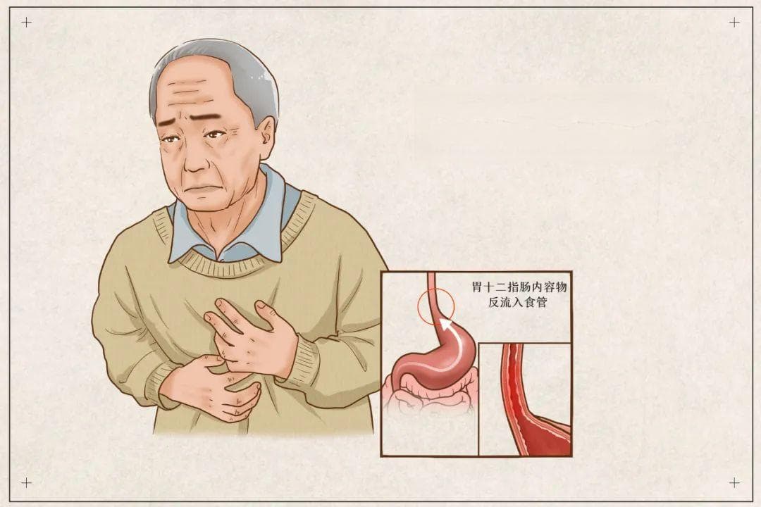有一种生不如死，叫“反流性食管炎”，4种方法给它“治”得服服帖帖