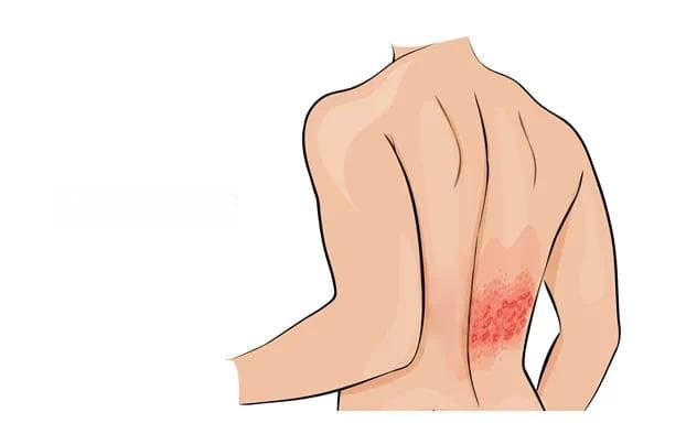 带状疱疹科普：水痘病毒一旦感染，终身携带！1个方法提前预防