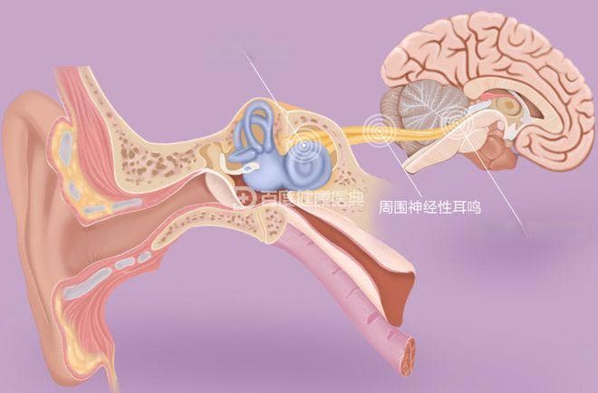神经性耳鸣诱因复杂，长期失眠焦虑是重要风险因素
