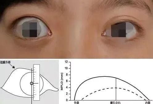 上睑退缩，用肉毒毒素好还是玻尿酸好？