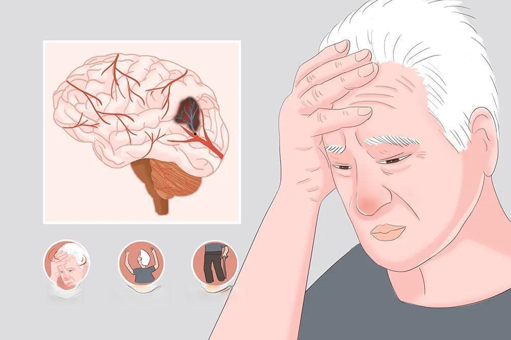 多发腔隙性脑梗塞是什么意思