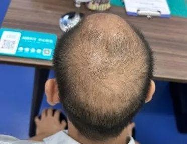 脱发掉发缺什么？脱发人应该怎么办?