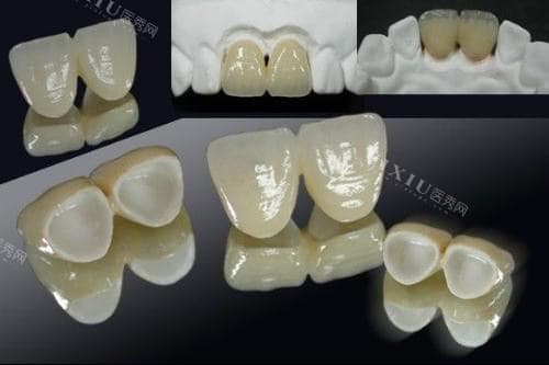 全瓷牙冠里面的真牙会烂吗？医生技术/术后维护不当/适应时间过长都有可能