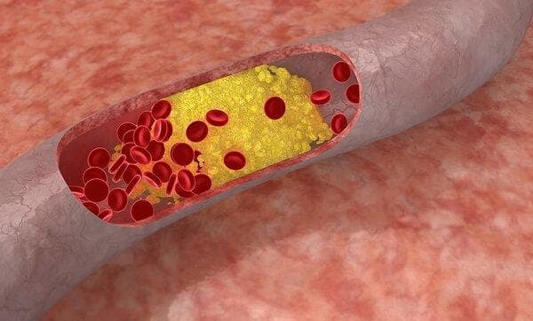 动脉斑块可能引发的5大症状及应对方法