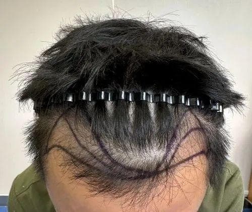 植发后又脱发了，是植发失败了吗？还有办法改善吗？