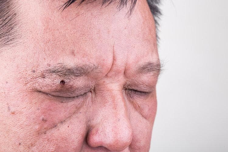 再三提醒：痣长在6个位置，大人小孩都要注意，可能有癌变的风险