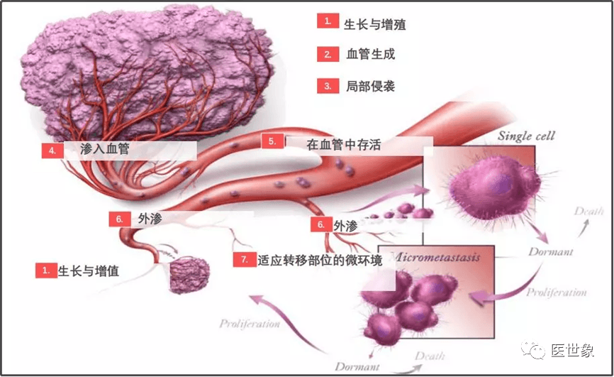 避免过度治疗！MammaPrint®等多基因检测工具指导乳腺癌术后辅助化疗的决策