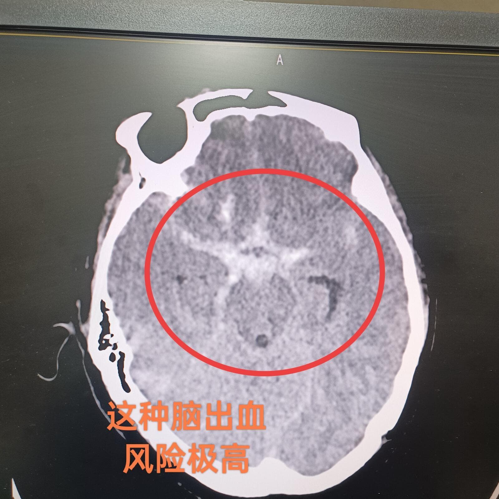 颅内不定时炸弹——动脉瘤怎么确诊？