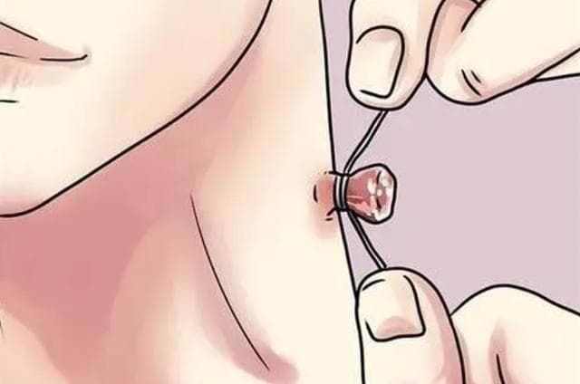 皮肤上的"小肉疙瘩"究竟是什么呢？医生道出答案，不妨对照自查