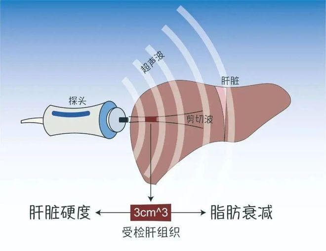 想知道肝脏“硬不硬”？肝弹检查记好这几个关键数字！