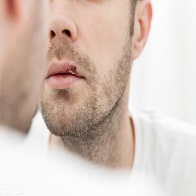 经常生口疮怎么办？做好四招避免经常生口疮