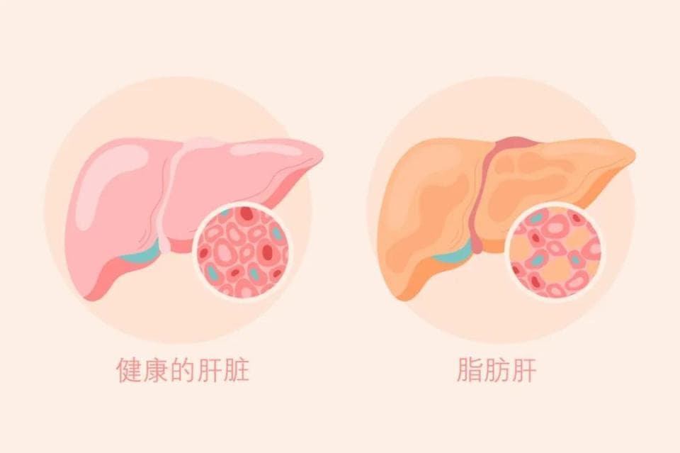 拒绝盲目减肥！中老年人群科学减重记住四个要点