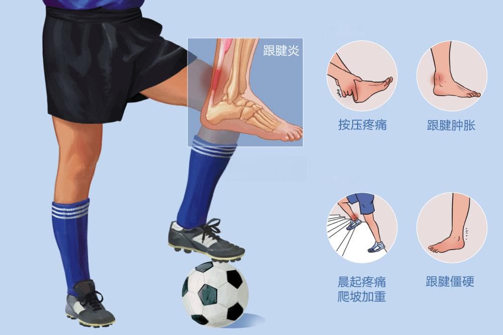 跟腱炎提早预防，避免伤痛