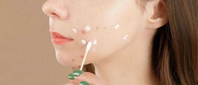 他扎罗汀乳膏治疗银屑病：有效控制病情但需维持治疗
