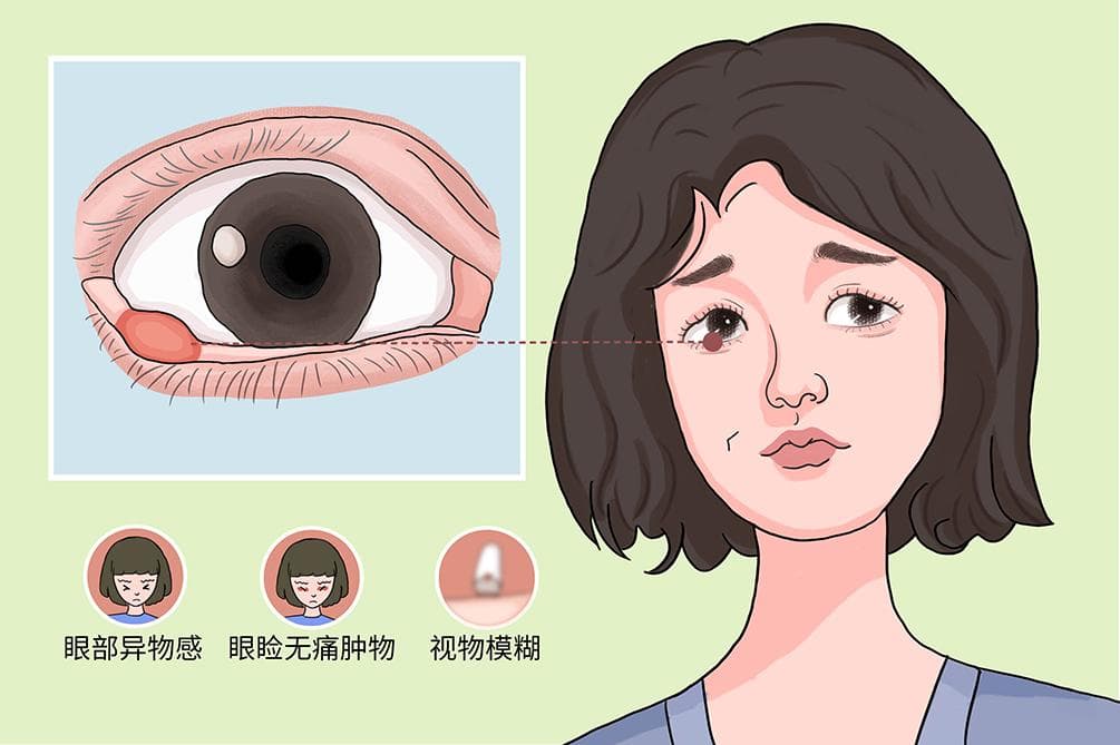 霰粒肿：症状、诊断与治疗全解析