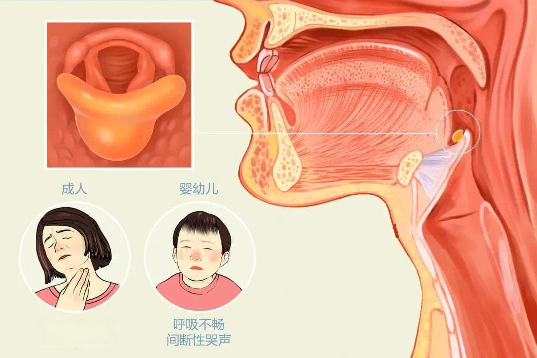 耳鼻喉科三大急症之“急性会厌炎”