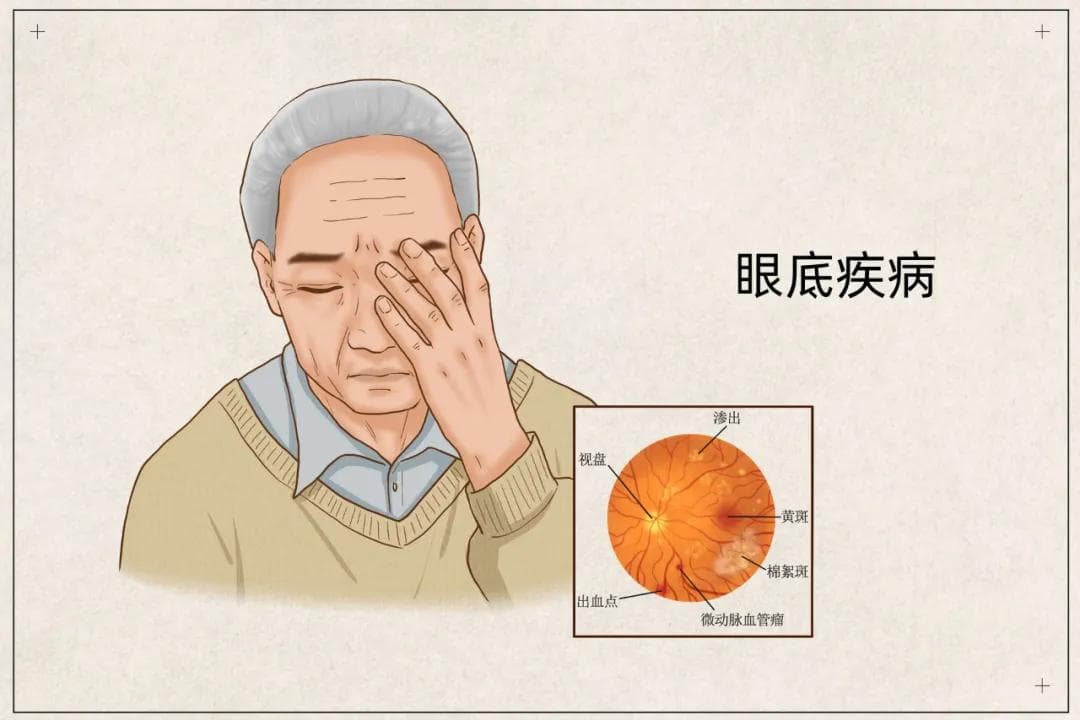 糖尿病性黄斑水肿，把握治疗时机才能化解视力危机