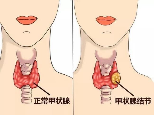 【健康科普】：全面了解甲状腺结节及其预防方法