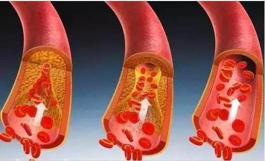 散步真的对血管有好处吗？做好这5件事效果比运动更好