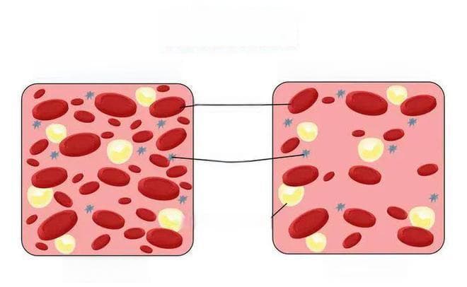 缺铁性贫血防治指南：症状识别与科学补铁
