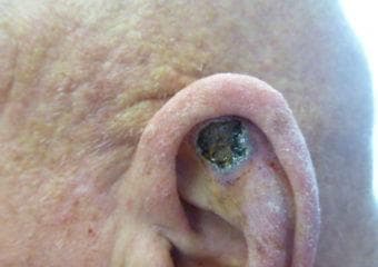 鳞状细胞癌：症状、危险性和发病率全解析