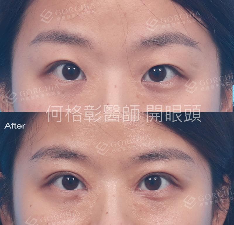开眼角手术详解：定义、方法、效果与术后护理