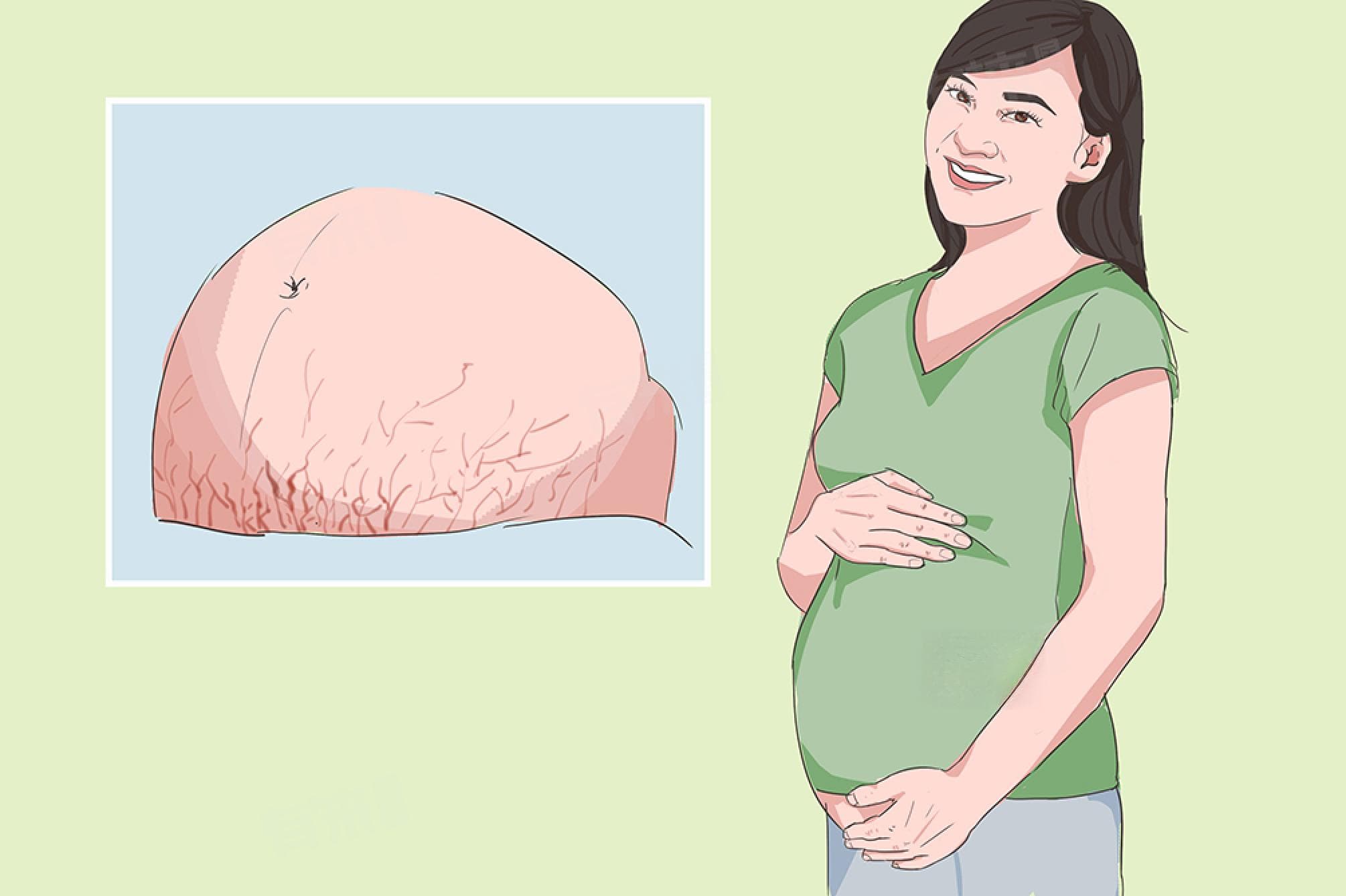 妊娠纹会遗传吗？