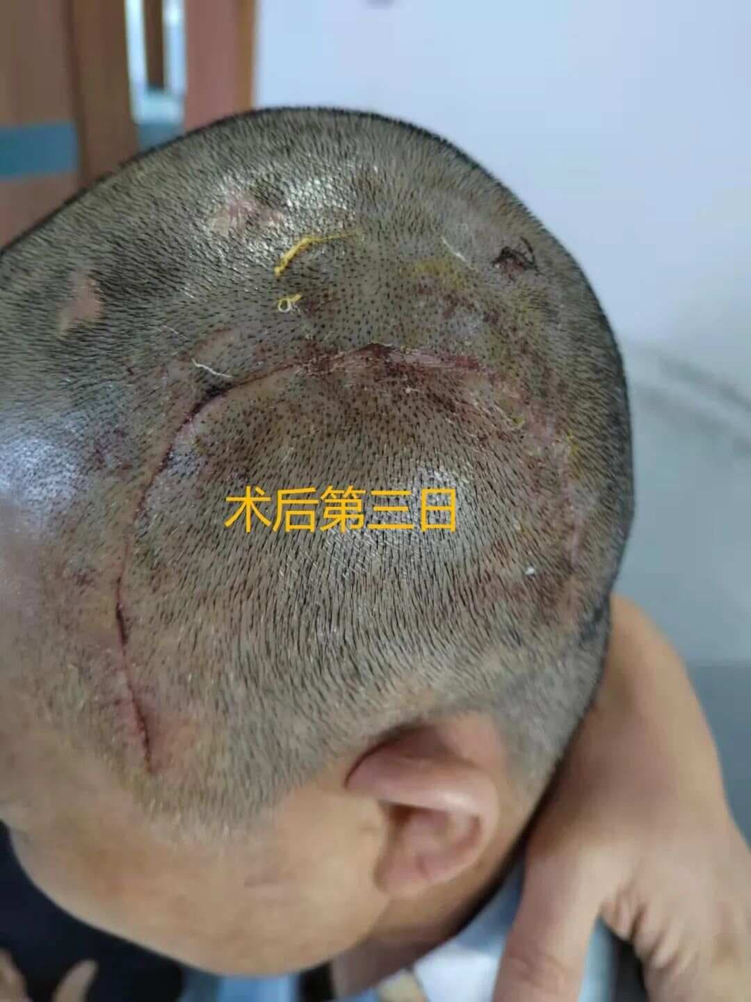 手术后伤口出现线结反应怎么办？