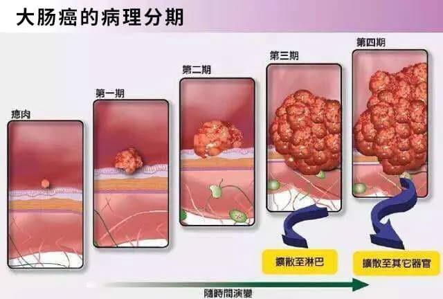 直肠癌在初期往往会被误诊为痔疮，如何辨别？