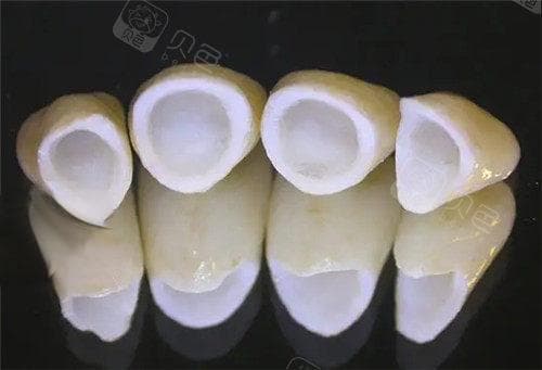 全瓷牙冠制作需要几天？详细介绍全瓷牙冠制作流程及时间周期，时间受多种因素影响！
