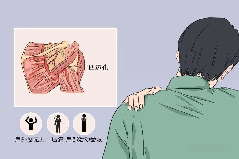 腋神经损伤的诊疗！从解剖到手法处理