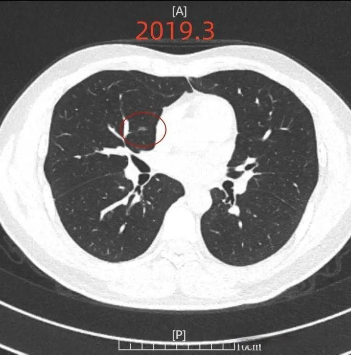 五年肺结节随访案例：何时该考虑手术？