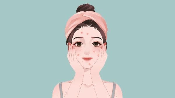 激素痘痘怎么消除