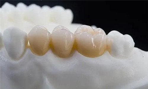 做的牙冠掉了还能用吗？可以的！妥善保存牙冠并尽快就医是关键！