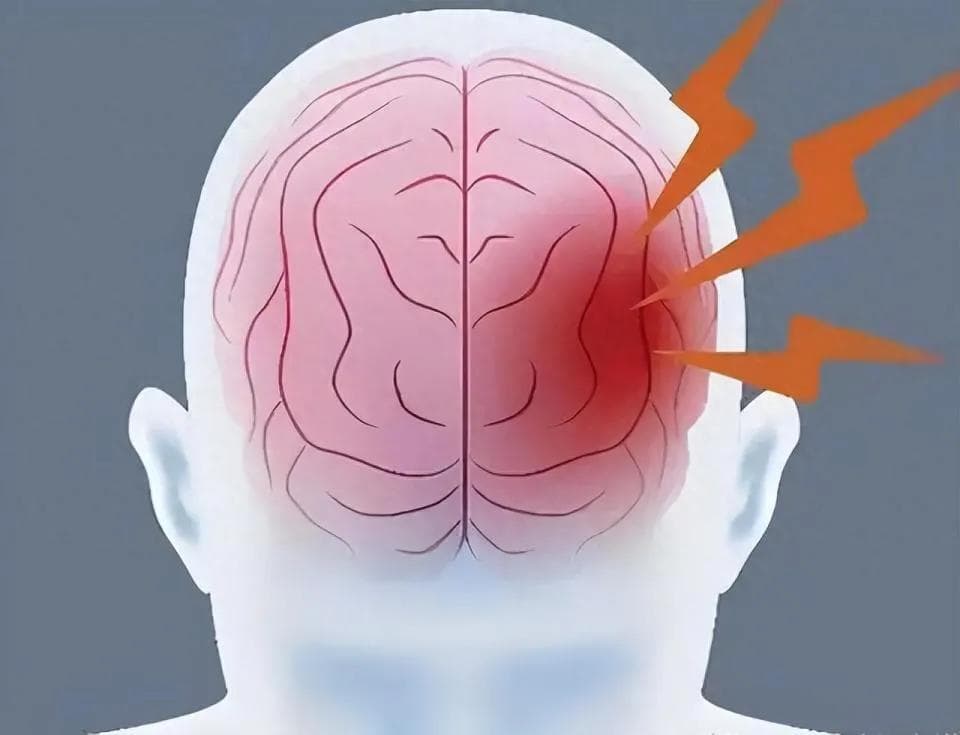 脑卒中里病死率最高、预后最差的疾病之一脑干出血！预防是关键！