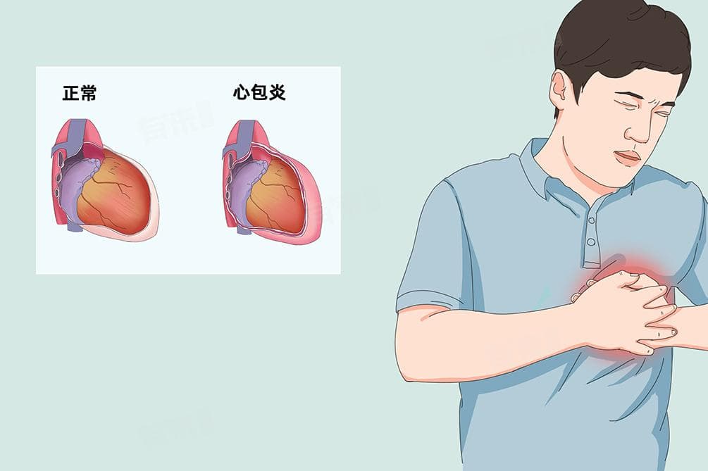 心包增厚可以恢复吗？关键因素与日常养护全解析