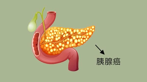 早期胰腺癌的诊断检查