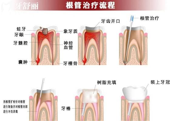 根管治疗一般人受得住吗？需要打麻药是可以承受的哦