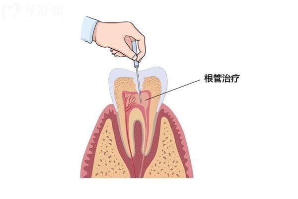 牙神经为什么会外露？症状＋治疗＋预防一文了解